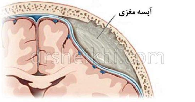 آبسه مغزی