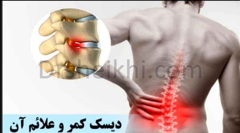 تشخیص علائم دیسک کمر