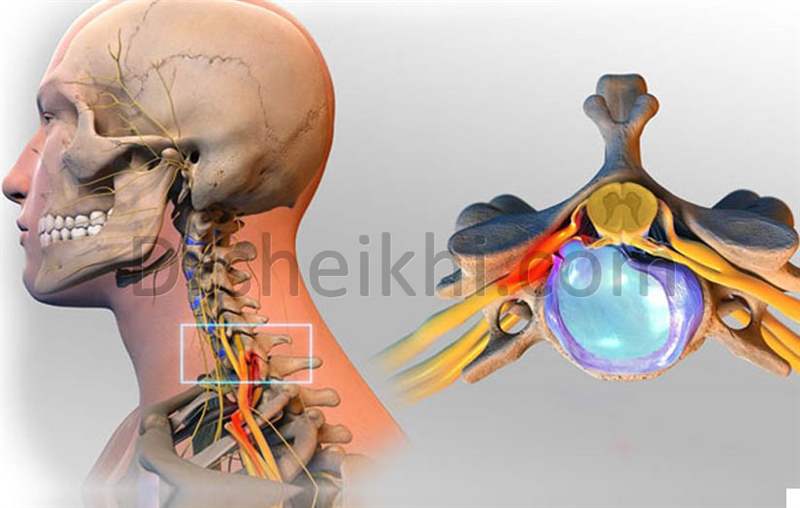 روش های جراحی دیسک گردن توسط جراح دیسک گردن