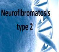  بیماری نوروفیبروماتوز نوع دو