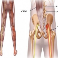 راههای درمان درد سیاتیک 