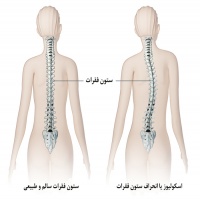 اسکولیوز(انحراف ستون فقرات)