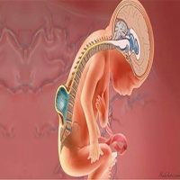 بیماری مادرزادی اسپینا بیفیدا یا مهره شکاف دار