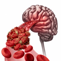 جراحی ضایعات عروقی مغزی و کاورنوما