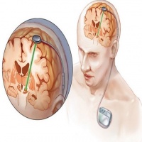 جراحی تحریک عمقی مغز