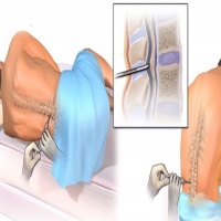 نمونه برداری از مایع مغزی و نخاعی بوسیله پونکسیون کمری