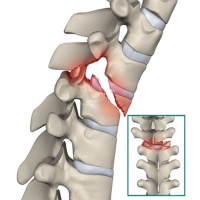 علائم و علل و راههای درمان شکستگی مهره های کمر 