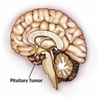 آدنوم تومور غده هیپوفیز