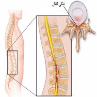 خطرات عمل تنگی کانال نخاع