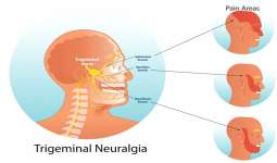 راههای درمان نورالژی عصب سه قلو 