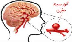 درمان آنوریسم مغزی پاره شده