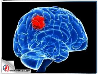 آیا تومورهای مغزی قابل درمان هستند ؟
