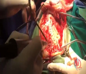 عمل جراحی خونریزی مغز (قسمت سوم)
